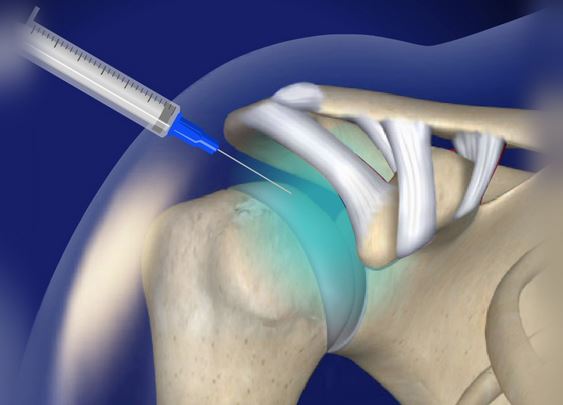 Before Steroid Injection